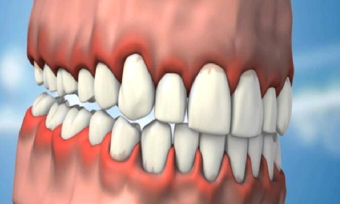 Dişeti Hastalıkları Tedavisi(Periodontoloji) Nedir?