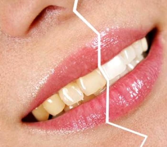 DİŞLERDE OLUŞAN RENKLENMELER