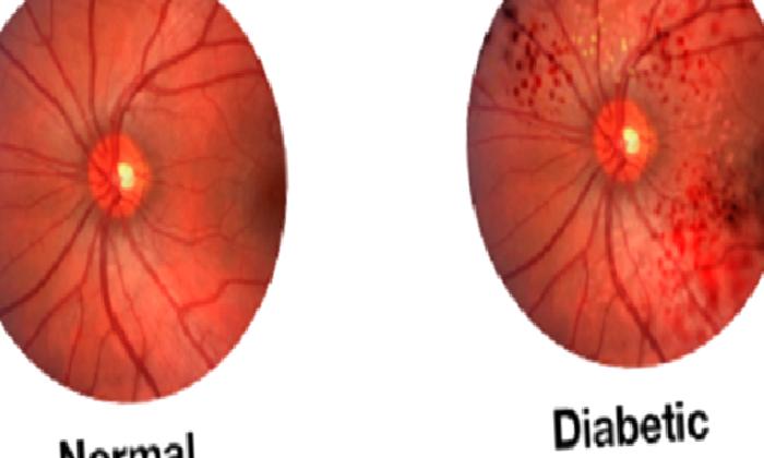 Diyabetik Retinopat