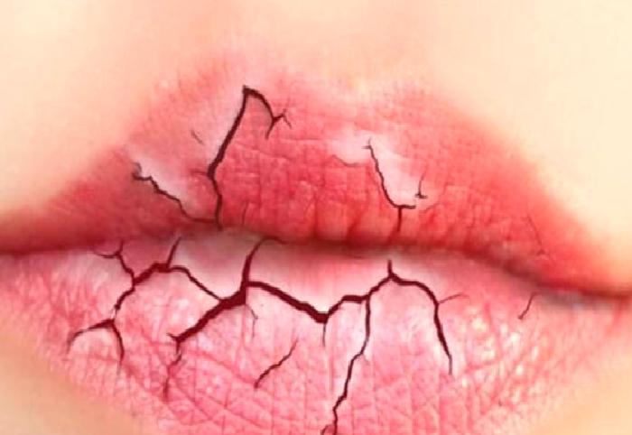 Doğal Dudak Dolgusu Hakkında Merak Edilenler