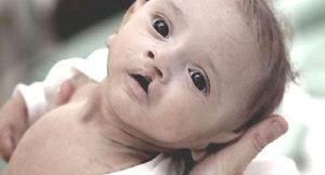 Doğumsal anomaliler – Dudak damak yarıkları