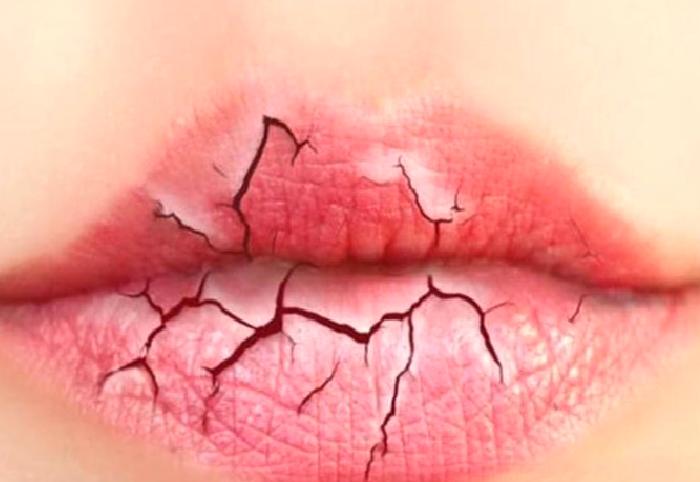 Dudak Dolgusu İle İlgili Bilinmesi Gereken Her Şey