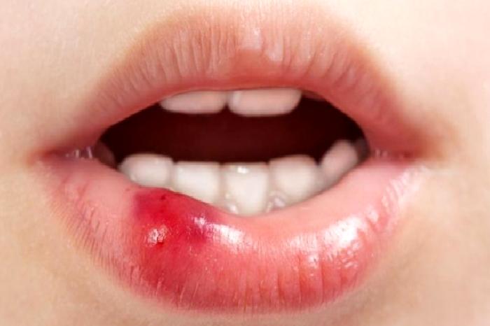 Dudak Kanserinin Teşhisi