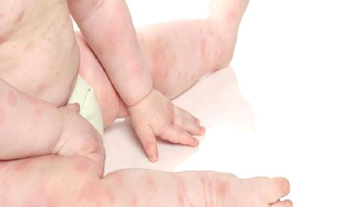 Ekzema (Dermatitler)