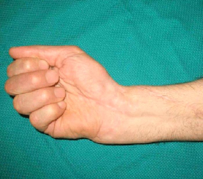 El Bileğinde Ganglion Kisti