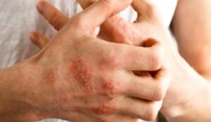 Ellerin Kaşındıran Izdırabı