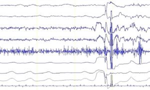 EMG Nedir? Ne Zaman Yapılır?