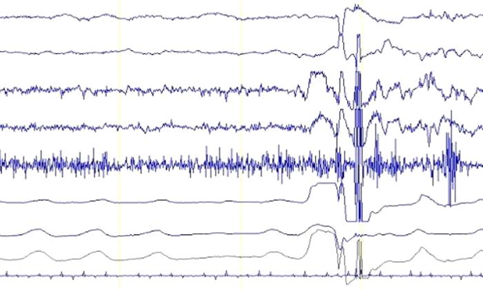 EMG Nedir? Ne Zaman Yapılır?