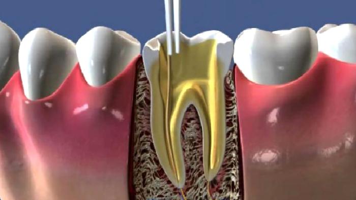 Endodonti / Kanal Tedavisi