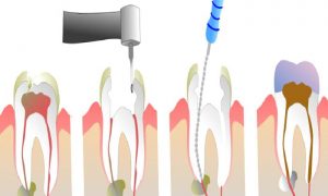 Endodonti Kanal Tedavisi