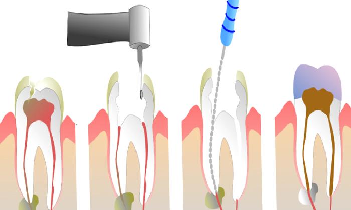 Endodonti Kanal Tedavisi