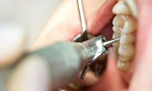 ENDODONTİ