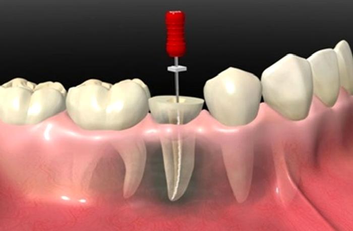 Endodontik (Kanal Tedavisi)