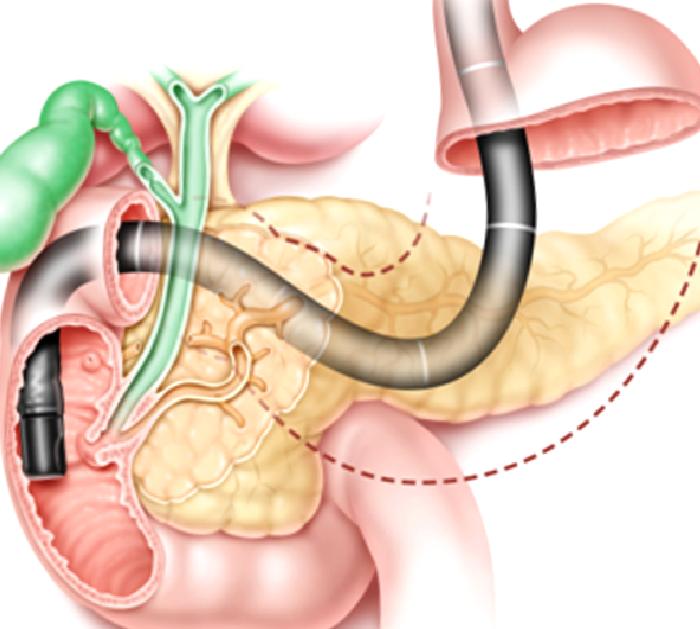 ERCP