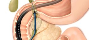 ERCP Nedir?