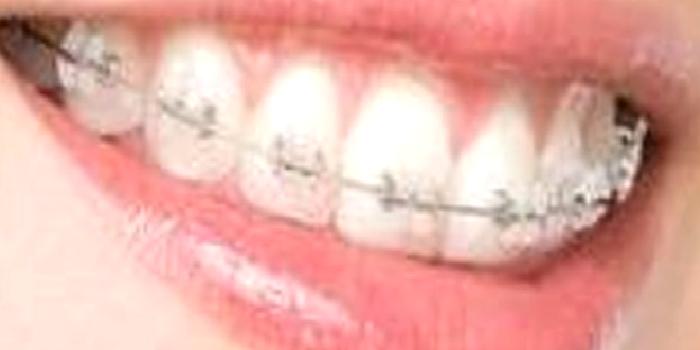 Erişkinlerde ortodontik tedavi