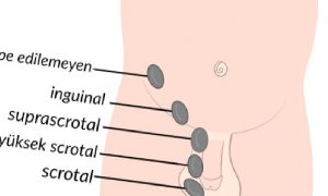ERKEK ÇOCUKLARDA YUMURTA İNMEMESİ