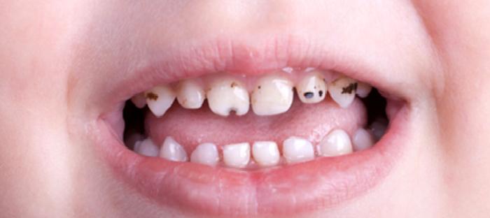 Erken Çocukluk Çağı Çürüğü (Biberon Çürüğü) Nedir? Tedavisi Nasıl Yapılır?