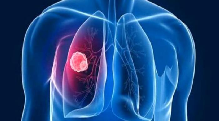 Erken Evre Akciğer Kanserinde Cerrahi