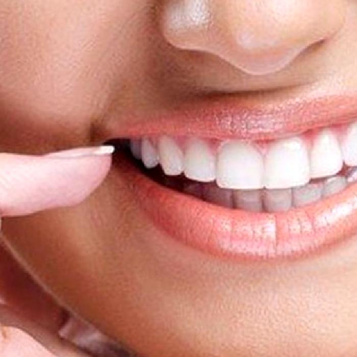 Estetik Diş Tedavisinde Bonding İşlemi Nedir?