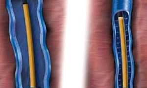 EXOTHERME VASKÜLER LAZER SİSTEMİ