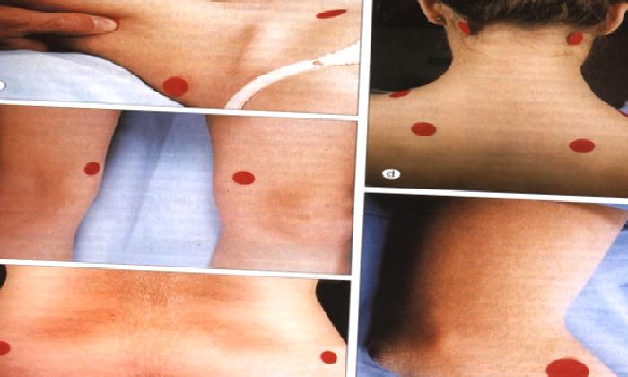 Fibromiyalji Nedir? Tedavisi Mümkün müdür?