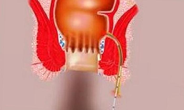 Fistül nedir?
