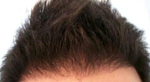 Fue Tekniği ile Saç Ekimi