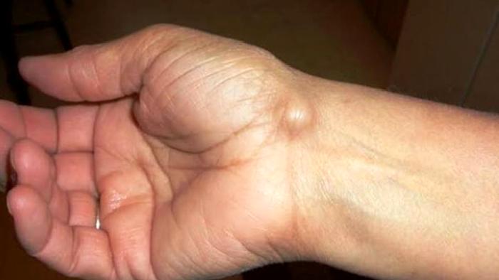 Ganglion Kisti