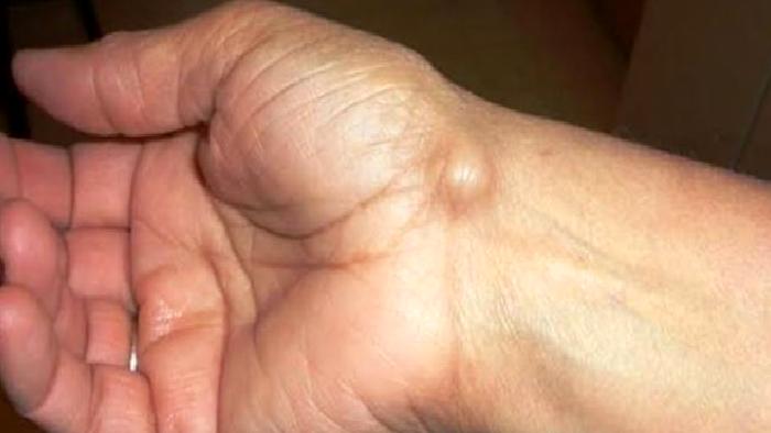 Ganglion Kisti Nedir?