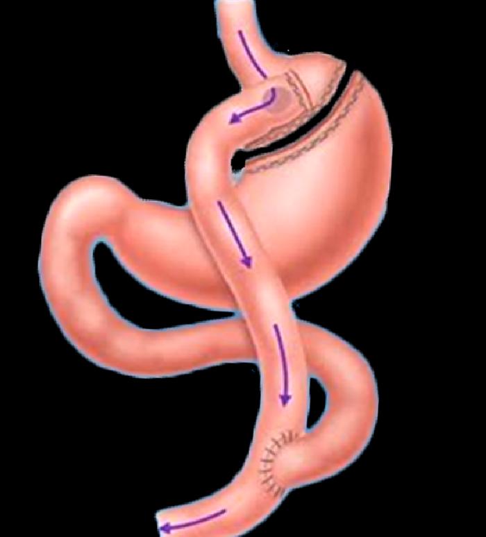 Gastrik Bypass