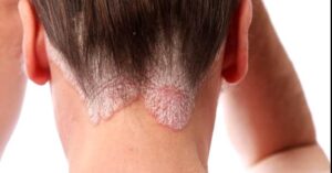 Genel Hatları İle Sedef Hastalığı