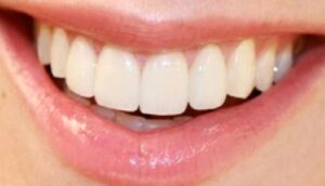 Gingivektomi Nedir?