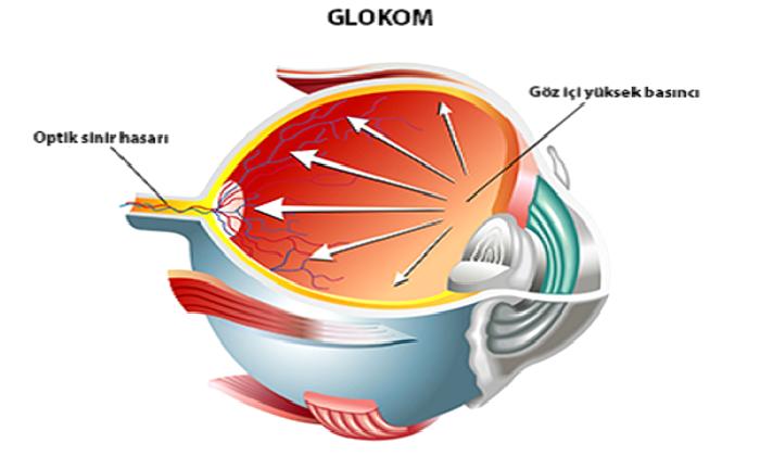 Glokom Tedavi Prensipleri