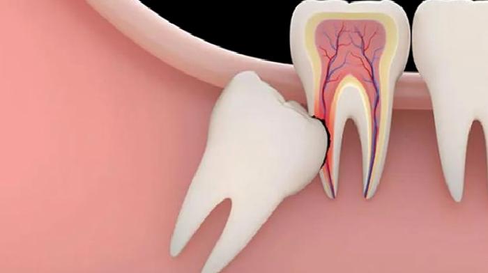 Gömülü 20 Yaş Diş Ameliyatları