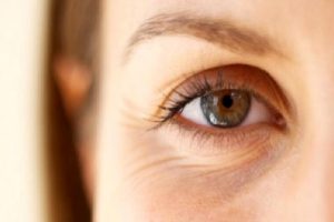 Göz çevresi kırışıklıkları tedavisi