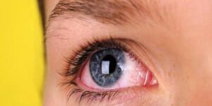 Göz Tansiyonu Nedir?