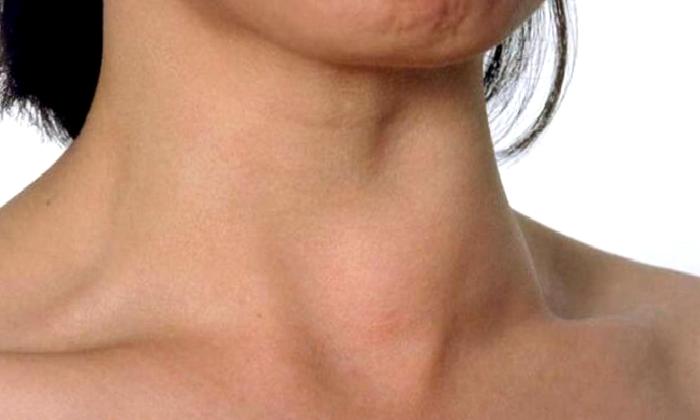 Guatr Tiroid Bezi Hastalığı