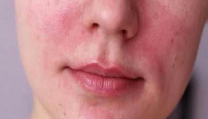 Gül Hastalığı ve Maske Kullanımı