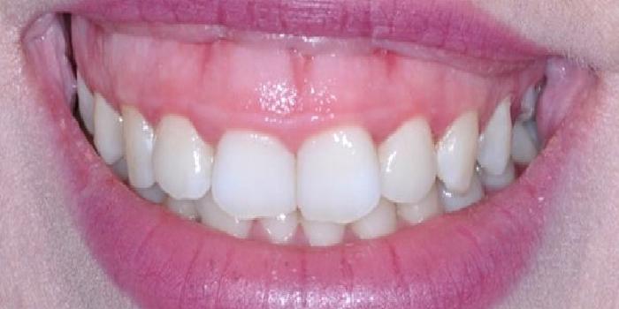 Gummy Smile (Diş Eti Görünmesi)