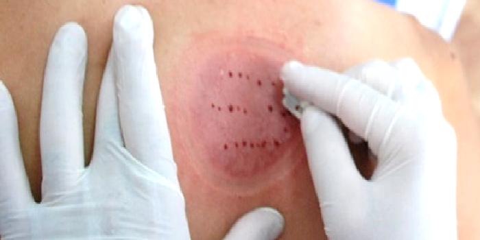 Hacamat / Kupa Tedavisi