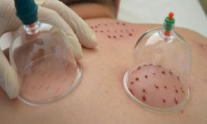 Hacamatla İlgili Bazı Hadisler