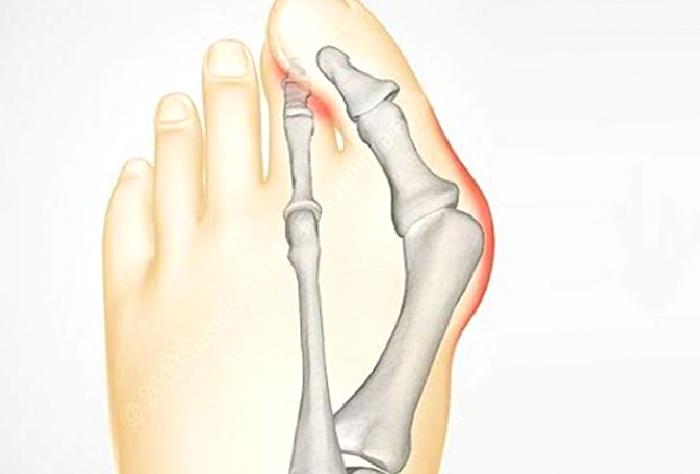 Halluks Valgus