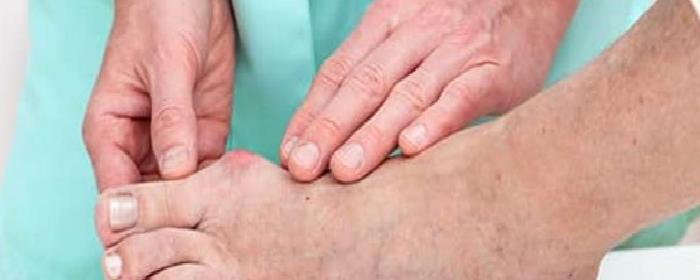 Halluks Valgus / Başparmak Çıkıntısı