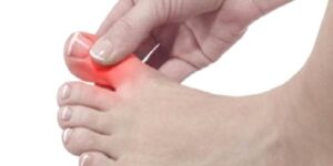 Halluks Valgus Nedir?