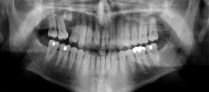 Hangi sıklıkla diş röntgenleri çektirmeliyim?