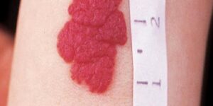 Hemanjiom Nedir, Nasıl Geçer, Nasıl Tedavi Edilir?