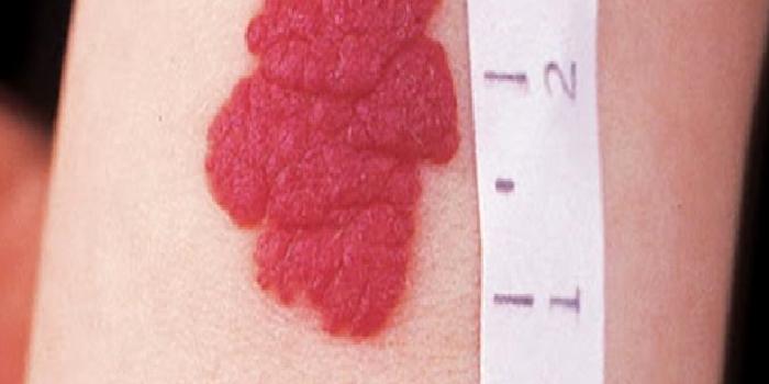 Hemanjiom Nedir, Nasıl Geçer, Nasıl Tedavi Edilir?