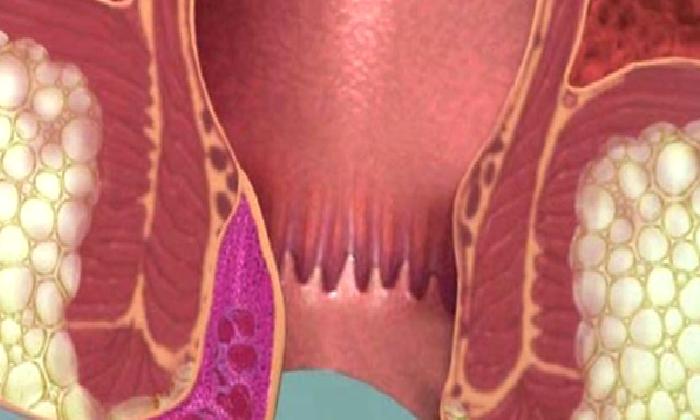 Hemoroid Ameliyatları