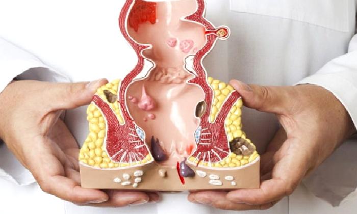 Hemoroid Deyip Geçmeyin!